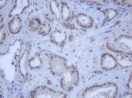 DDX59 Antibody - IHC of paraffin-embedded Carcinoma of Human prostate tissue using anti-DDX59 mouse monoclonal antibody.