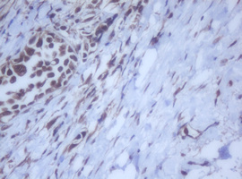 DDX59 Antibody - IHC of paraffin-embedded Carcinoma of Human bladder tissue using anti-DDX59 mouse monoclonal antibody.