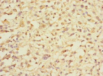 DDX59 Antibody - Immunohistochemistry of paraffin-embedded human melanoma using DDX59 Antibody at dilution of 1:100