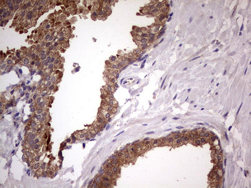 DDX6 Antibody - Immunohistochemical staining of paraffin-embedded Carcinoma of Human prostate tissue using anti-DDX6 mouse monoclonal antibody. (Heat-induced epitope retrieval by 1 mM EDTA in 10mM Tris, pH8.5, 120C for 3min,