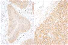 DDX6 Antibody - Detection of Human and Mouse DDX6 by Immunohistochemistry. Sample: FFPE section of human colon carcinoma (left) and mouse renal cell carcinoma (right). Antibody: Affinity purified rabbit anti-DDX6 used at a dilution of 1:200 (1 ug/ml). Detection: DAB.