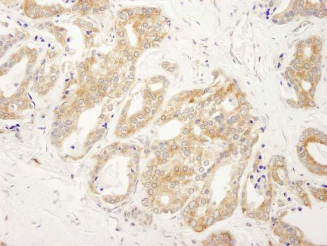 DDX6 Antibody - Detection of Human DDX6 by Immunohistochemistry. Sample: FFPE section of human prostate carcinoma. Antibody: Affinity purified rabbit anti-DDX6 used at a dilution of 1:250.