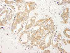 DDX6 Antibody - Detection of Human DDX6 by Immunohistochemistry. Sample: FFPE section of human prostate carcinoma. Antibody: Affinity purified rabbit anti-DDX6 used at a dilution of 1:250.