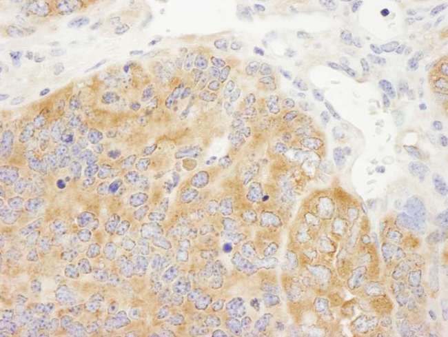 DDX6 Antibody - Detection of Mouse DDX6 by Immunohistochemistry. Sample: FFPE section of mouse renal cell carcinoma. Antibody: Affinity purified rabbit anti-DDX6 used at a dilution of 1:250.