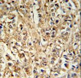 DDX6 Antibody - DDX6 Antibody IHC of formalin-fixed and paraffin-embedded breast carcinoma followed by peroxidase-conjugated secondary antibody and DAB staining.