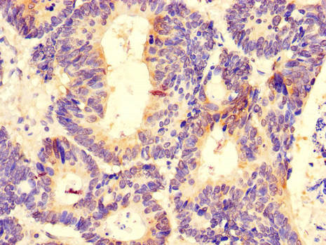 DDX6 Antibody - Immunohistochemistry of paraffin-embedded human colon cancer using DDX6 Antibody at dilution of 1:100