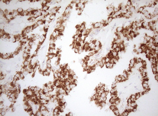 DECR1 Antibody - Immunohistochemical staining of paraffin-embedded Carcinoma of Human thyroid tissue using anti-DECR1 mouse monoclonal antibody. (Heat-induced epitope retrieval by 1mM EDTA in 10mM Tris buffer. (pH8.5) at 120°C for 3 min. (1:150)