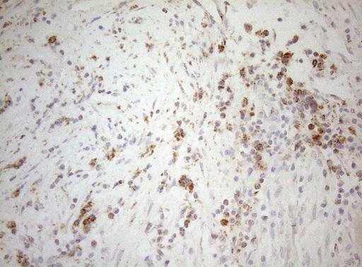 DECR1 Antibody - Immunohistochemical staining of paraffin-embedded Carcinoma of Human bladder tissue using anti-DECR1 mouse monoclonal antibody. (Heat-induced epitope retrieval by 1mM EDTA in 10mM Tris buffer. (pH8.5) at 120°C for 3 min. (1:150)