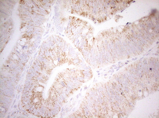 DECR1 Antibody - Immunohistochemical staining of paraffin-embedded Carcinoma of Human pancreas tissue using anti-DECR1 mouse monoclonal antibody. (Heat-induced epitope retrieval by 1mM EDTA in 10mM Tris buffer. (pH8.5) at 120°C for 3 min. (1:150)