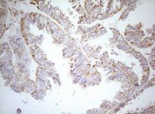 DECR1 Antibody - Immunohistochemical staining of paraffin-embedded Adenocarcinoma of Human ovary tissue using anti-DECR1 mouse monoclonal antibody. (Heat-induced epitope retrieval by 1mM EDTA in 10mM Tris buffer. (pH8.5) at 120°C for 3 min. (1:150)