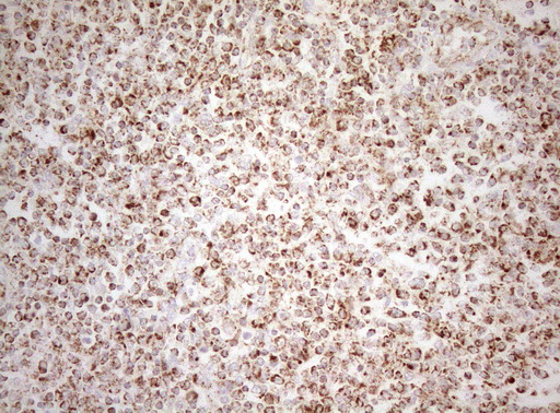 DECR1 Antibody - Immunohistochemical staining of paraffin-embedded Human lymphoma tissue using anti-DECR1 mouse monoclonal antibody. (Heat-induced epitope retrieval by 1mM EDTA in 10mM Tris buffer. (pH8.5) at 120°C for 3 min. (1:150)