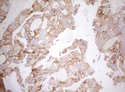 DECR1 Antibody - Immunohistochemical staining of paraffin-embedded Adenocarcinoma of Human breast tissue tissue using anti-DECR1 mouse monoclonal antibody. (Heat-induced epitope retrieval by 1mM EDTA in 10mM Tris buffer. (pH8.5) at 120°C for 3 min. (1:150)