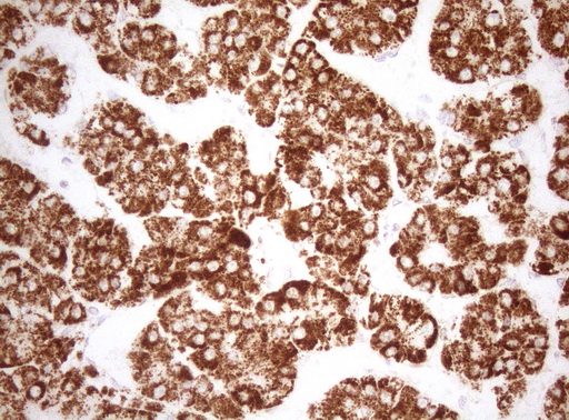 DECR1 Antibody - Immunohistochemical staining of paraffin-embedded Carcinoma of Human liver tissue using anti-DECR1 mouse monoclonal antibody. (Heat-induced epitope retrieval by 1mM EDTA in 10mM Tris buffer. (pH8.5) at 120°C for 3 min. (1:150)