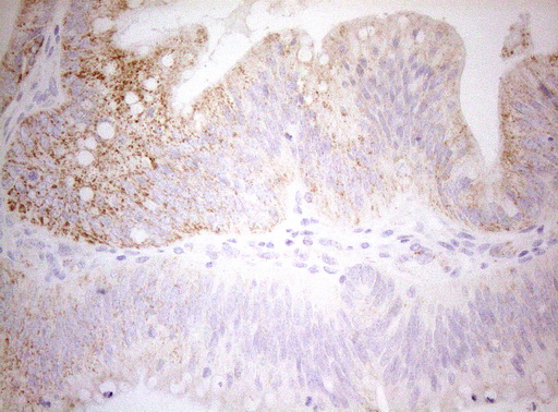 DECR1 Antibody - Immunohistochemical staining of paraffin-embedded Carcinoma of Human pancreas tissue using anti-DECR1 mouse monoclonal antibody. (Heat-induced epitope retrieval by 1mM EDTA in 10mM Tris buffer. (pH8.5) at 120°C for 3 min. (1:150)