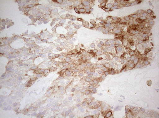 DECR1 Antibody - Immunohistochemical staining of paraffin-embedded Adenocarcinoma of Human breast tissue tissue using anti-DECR1 mouse monoclonal antibody. (Heat-induced epitope retrieval by 1mM EDTA in 10mM Tris buffer. (pH8.5) at 120°C for 3 min. (1:150)
