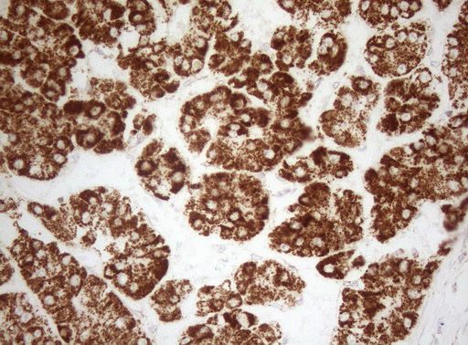 DECR1 Antibody - Immunohistochemical staining of paraffin-embedded Carcinoma of Human liver tissue using anti-DECR1 mouse monoclonal antibody. (Heat-induced epitope retrieval by 1mM EDTA in 10mM Tris buffer. (pH8.5) at 120°C for 3 min. (1:150)