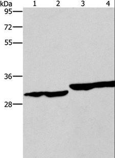 DECR1 Antibody - Western blot analysis of Human endometrial carcinoma and colon cancer tissue, human fetal liver tissue and PC3 cell, using DECR1 Polyclonal Antibody at dilution of 1:300.