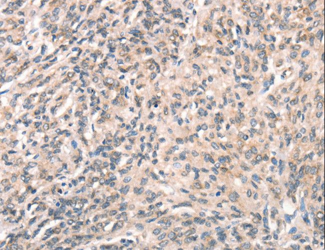 DECR1 Antibody - Immunohistochemistry of paraffin-embedded Human prostate cancer using DECR1 Polyclonal Antibody at dilution of 1:50.