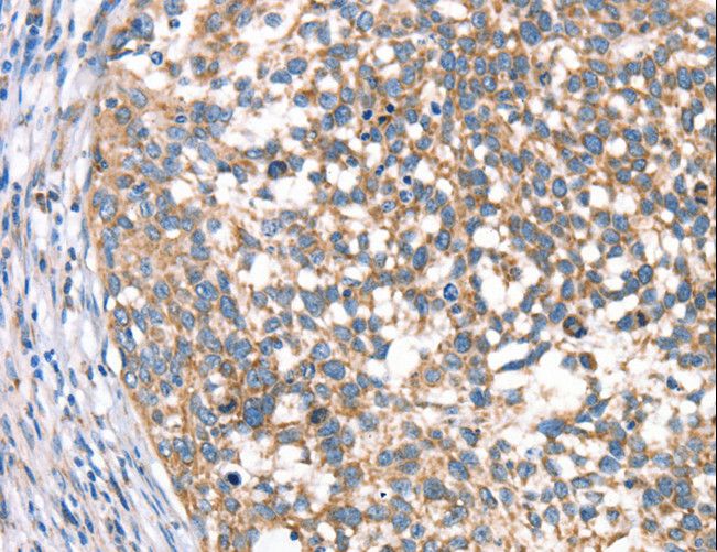 DECR1 Antibody - Immunohistochemistry of paraffin-embedded Human cervical cancer using DECR1 Polyclonal Antibody at dilution of 1:40.