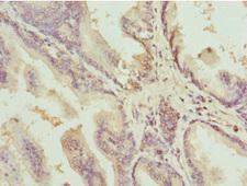 DEDD Antibody - Immunohistochemistry of paraffin-embedded human prostate cancer at dilution 1:100