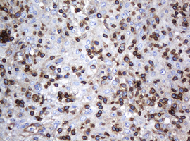 DEF6 Antibody - IHC of paraffin-embedded Human lymphoma tissue using anti-DEF6 mouse monoclonal antibody. (Heat-induced epitope retrieval by 10mM citric buffer, pH6.0, 120°C for 3min).