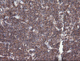 DEF6 Antibody - IHC of paraffin-embedded Human lymphoma tissue using anti-DEF6 mouse monoclonal antibody. (Heat-induced epitope retrieval by 10mM citric buffer, pH6.0, 100C for 10min).