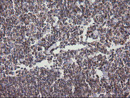 DEF6 Antibody - IHC of paraffin-embedded Human lymphoma tissue using anti-DEF6 mouse monoclonal antibody.