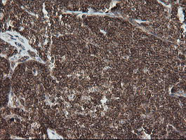 DEF6 Antibody - IHC of paraffin-embedded Human lymphoma tissue using anti-DEF6 mouse monoclonal antibody. (Heat-induced epitope retrieval by 10mM citric buffer, pH6.0, 100C for 10min).