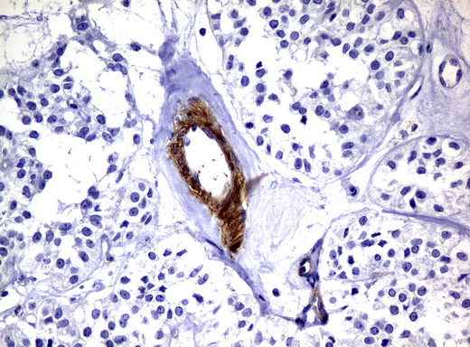 DEF6 Antibody - Immunohistochemical staining of paraffin-embedded Carcinoma of Human pancreas tissue using anti-DEF6 mouse monoclonal antibody.  heat-induced epitope retrieval by 10mM citric buffer, pH6.0, 120C for 3min)