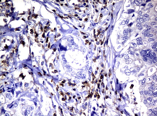 DEF6 Antibody - Immunohistochemical staining of paraffin-embedded Adenocarcinoma of Human breast tissue using anti-DEF6 mouse monoclonal antibody.  heat-induced epitope retrieval by 10mM citric buffer, pH6.0, 120C for 3min)