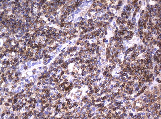 DEF6 Antibody - Immunohistochemical staining of paraffin-embedded Human lymphoma tissue using anti-DEF6 mouse monoclonal antibody.  heat-induced epitope retrieval by 10mM citric buffer, pH6.0, 120C for 3min)