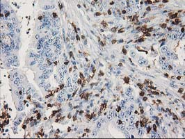 DEF8 Antibody - IHC of paraffin-embedded Adenocarcinoma of Human colon tissue using anti-DEF8 mouse monoclonal antibody. (Heat-induced epitope retrieval by 10mM citric buffer, pH6.0, 100C for 10min).