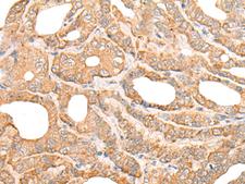 DEF8 Antibody - Immunohistochemistry of paraffin-embedded Human thyroid cancer tissue  using DEF8 Polyclonal Antibody at dilution of 1:25(×200)
