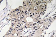 DEFA1 / Defensin Alpha 1 Antibody - Immunohistochemistry analysis of Defensin Î±1 antibody in paraffin-embedded human breast carcinoma tissue.