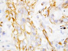 DEFB1 / BD-1 Antibody - DEFB1 / Beta Defensin 1 antibody. IHC(P): Lung Cancer Tissue.