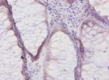 DEFB1 / BD-1 Antibody - Immunohistochemistry of paraffin-embedded human colon cancer using DEFB1 Antibody at dilution of 1:50