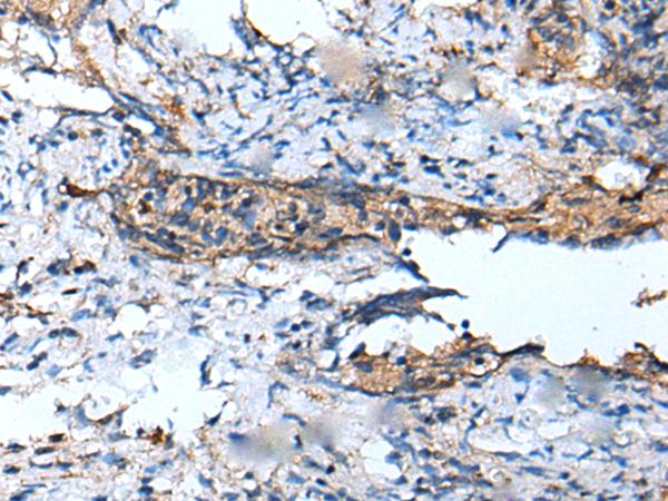DEFB104A / BD-4 Antibody - Immunohistochemistry of paraffin-embedded Human cervical cancer tissue  using DEFB104A Polyclonal Antibody at dilution of 1:50(×200)