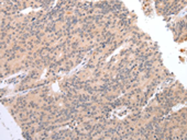 DEFB112 Antibody - Immunohistochemistry of paraffin-embedded Human prost at e cancer tissue  using DEFB112 Polyclonal Antibody at dilution of 1:40(×200)