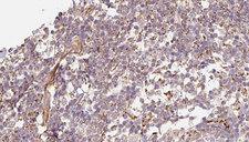 DEFB121 Antibody - 1:100 staining human Melanoma tissue by IHC-P. The sample was formaldehyde fixed and a heat mediated antigen retrieval step in citrate buffer was performed. The sample was then blocked and incubated with the antibody for 1.5 hours at 22°C. An HRP conjugated goat anti-rabbit antibody was used as the secondary.
