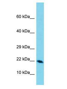 DEFB129 Antibody - DEFB129 antibody Western Blot of Esophagus Tumor. Antibody dilution: 1 ug/ml.  This image was taken for the unconjugated form of this product. Other forms have not been tested.