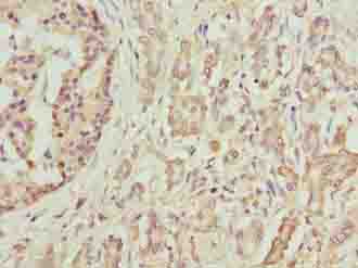 DEFB129 Antibody - Immunohistochemistry of paraffin-embedded human pancreatic cancer using antibody at dilution of 1:100.