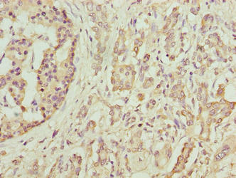 DEFB129 Antibody - Immunohistochemistry of paraffin-embedded human pancreatic cancer using DEFB129 Antibody at dilution of 1:100