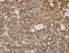 DEGS1 Antibody - Immunohistochemistry of paraffin-embedded Human liver cancer using DEGS1 Polyclonal Antibody at dilution of 1:30.