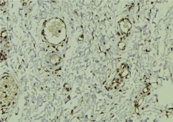 DEK Antibody - 1:100 staining human breast carcinoma tissue by IHC-P. The sample was formaldehyde fixed and a heat mediated antigen retrieval step in citrate buffer was performed. The sample was then blocked and incubated with the antibody for 1.5 hours at 22°C. An HRP conjugated goat anti-rabbit antibody was used as the secondary.