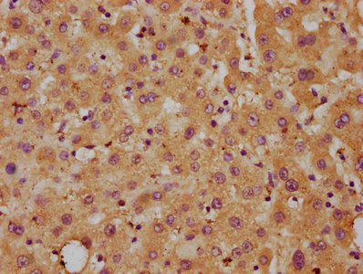Delta3 / DLL3 Antibody - IHC image of DLL3 Antibody diluted at 1:700 and staining in paraffin-embedded human liver tissue performed on a Leica BondTM system. After dewaxing and hydration, antigen retrieval was mediated by high pressure in a citrate buffer (pH 6.0). Section was blocked with 10% normal goat serum 30min at RT. Then primary antibody (1% BSA) was incubated at 4°C overnight. The primary is detected by a biotinylated secondary antibody and visualized using an HRP conjugated SP system.