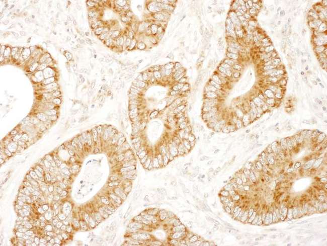 DENN / MADD Antibody - Detection of Human MADD by Immunohistochemistry. Sample: FFPE section of human colon carcinoma. Antibody: Affinity purified rabbit anti-MADD used at a dilution of 1:100.