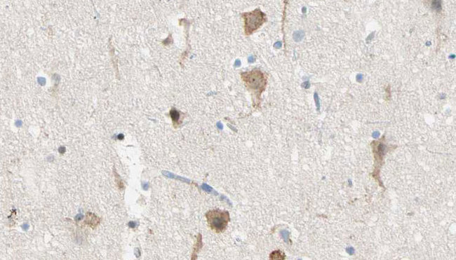 DENN / MADD Antibody - 1:100 staining human brain carcinoma tissue by IHC-P. The sample was formaldehyde fixed and a heat mediated antigen retrieval step in citrate buffer was performed. The sample was then blocked and incubated with the antibody for 1.5 hours at 22°C. An HRP conjugated goat anti-rabbit antibody was used as the secondary.