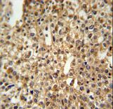DENND1A Antibody - DEN1A Antibody IHC of formalin-fixed and paraffin-embedded human cervix carcinoma followed by peroxidase-conjugated secondary antibody and DAB staining.