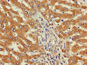 DEPDC1B Antibody - Immunohistochemistry image of paraffin-embedded human liver cancer at a dilution of 1:100