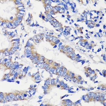 DEPTOR / DEPDC6 Antibody - Immunohistochemistry of paraffin-embedded Human colon carcinoma using DEPDC6 Polyclonal Antibody at dilution of 1:200 (40x lens).